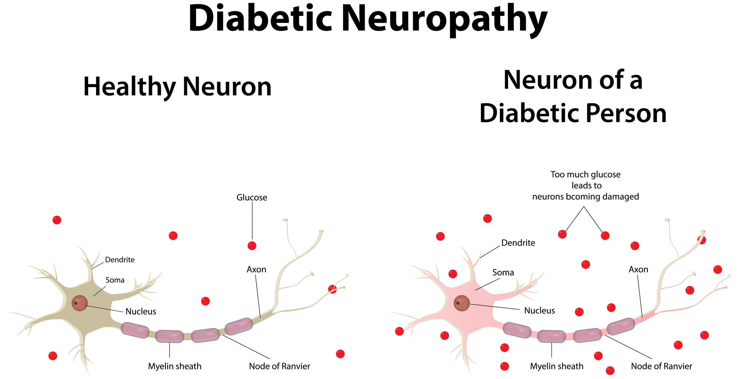 How to Prevent Diabetic Neuropathy